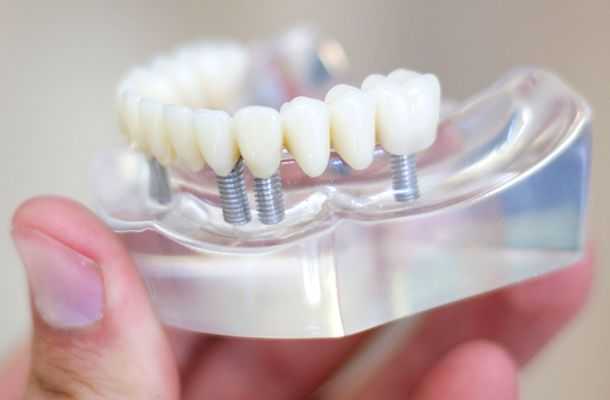 dental-implantlar-nasil-kullanilir