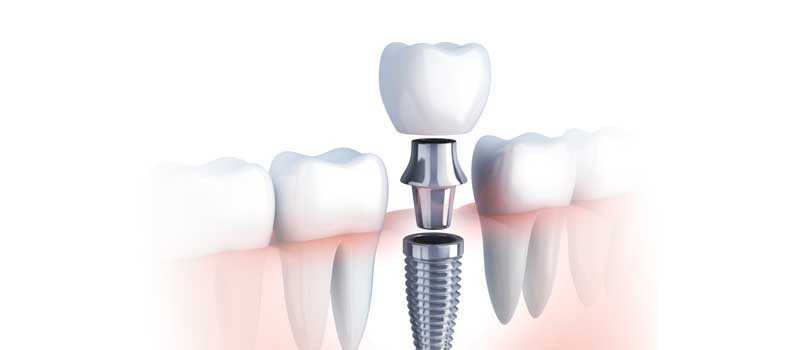 diş implantı