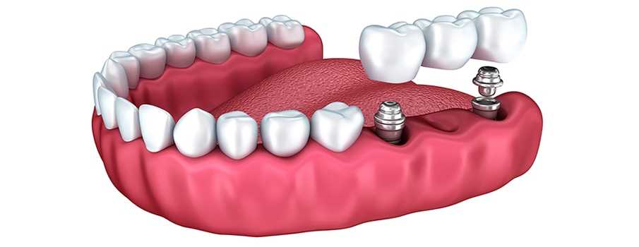 implant nasıl yapılır