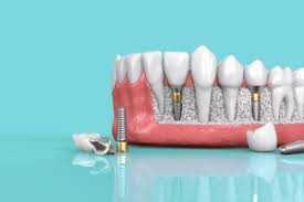 dental implant komplikasyonları