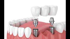 dental implant diş fiyatları