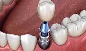 dental implant forum