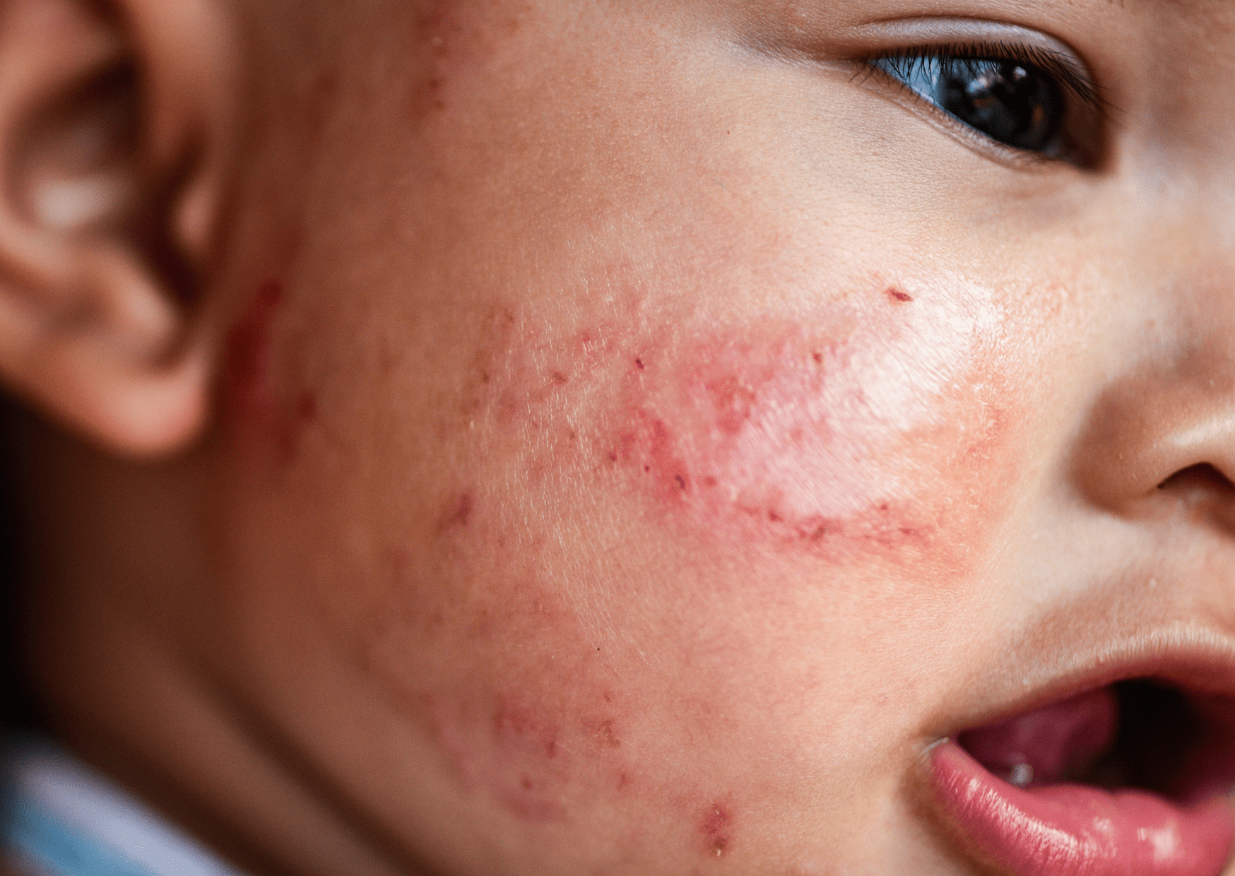 Egzama atopik (dermatit) nedir?