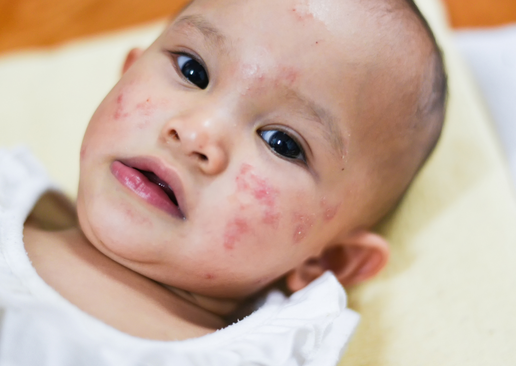 egzama atopik dermatit nedir anne bebek kulubu